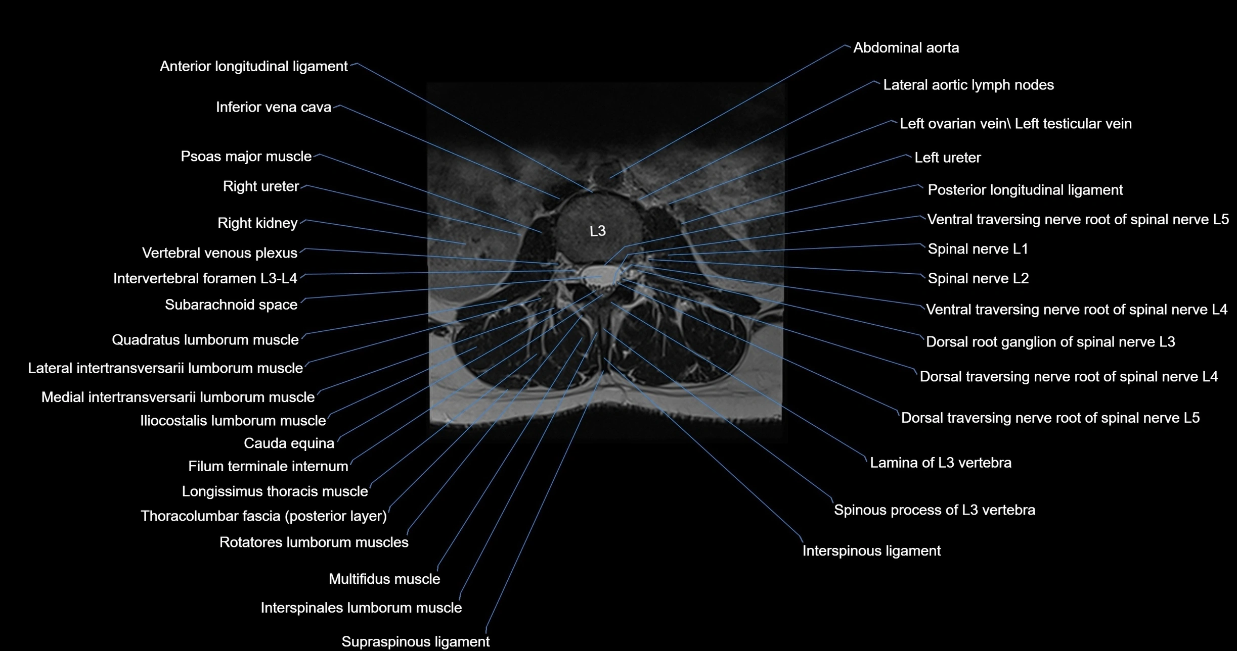 MRI lumbar spine axial cross sectional anatomy 3T radiology  image-img-00001-00024.webp